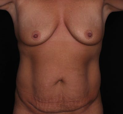 Breast Augmentation with Lift Before & After Gallery - Patient 213324 - Image 1