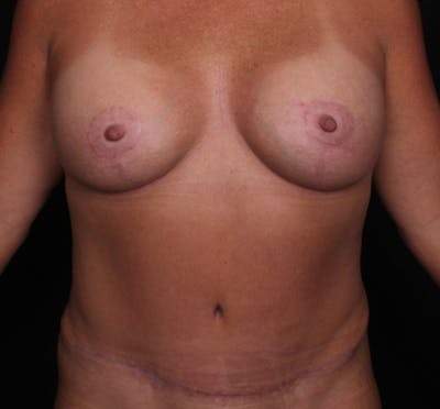 Breast Augmentation with Lift Before & After Gallery - Patient 213324 - Image 2