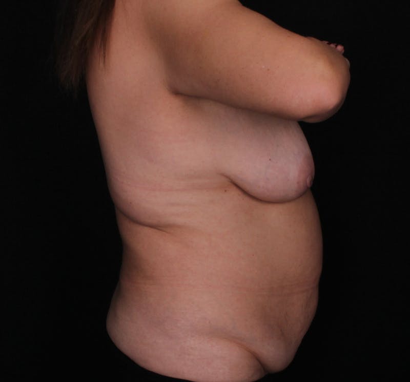 Abdominoplasty Before & After Gallery - Patient 385842 - Image 5