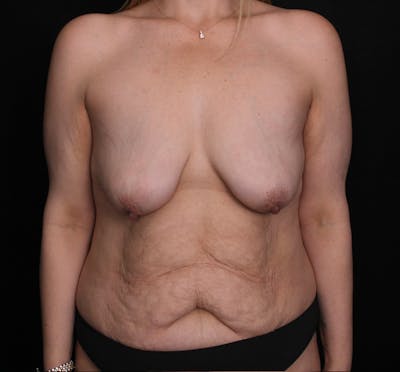 Breast Lift Before & After Gallery - Patient 357672 - Image 1