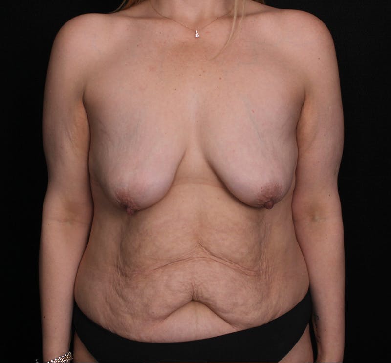 Breast Lift Before & After Gallery - Patient 357672 - Image 1