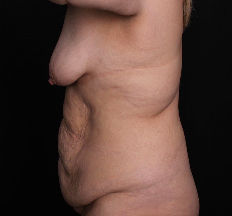 Breast Lift Before & After Gallery - Patient 357672 - Image 3