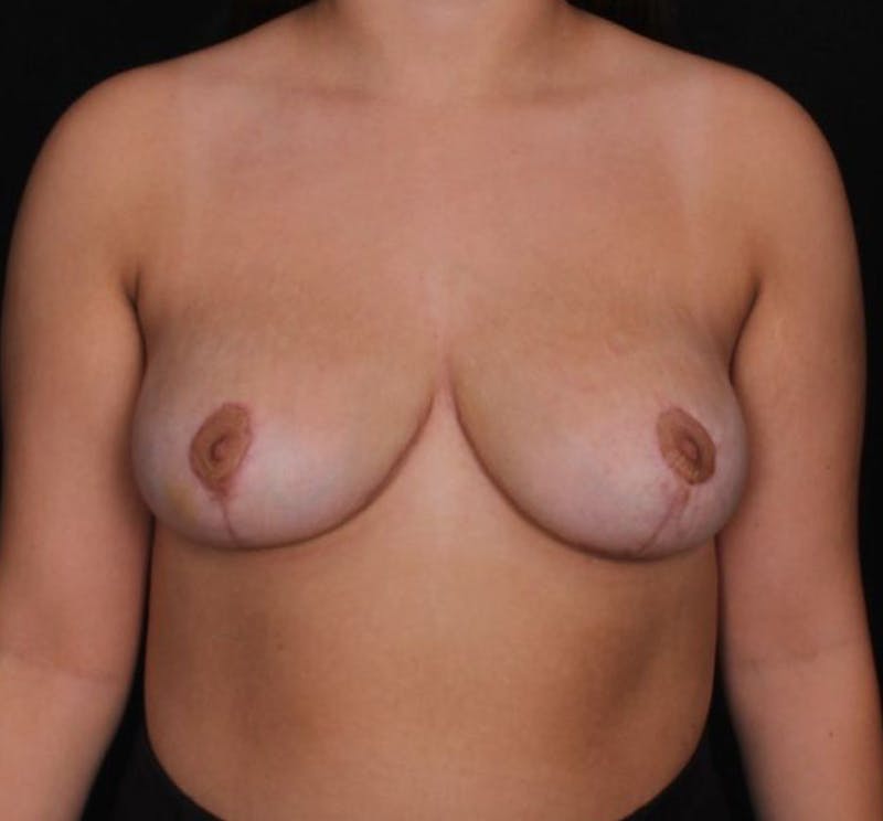 Breast Reduction Before & After Gallery - Patient 301283 - Image 2