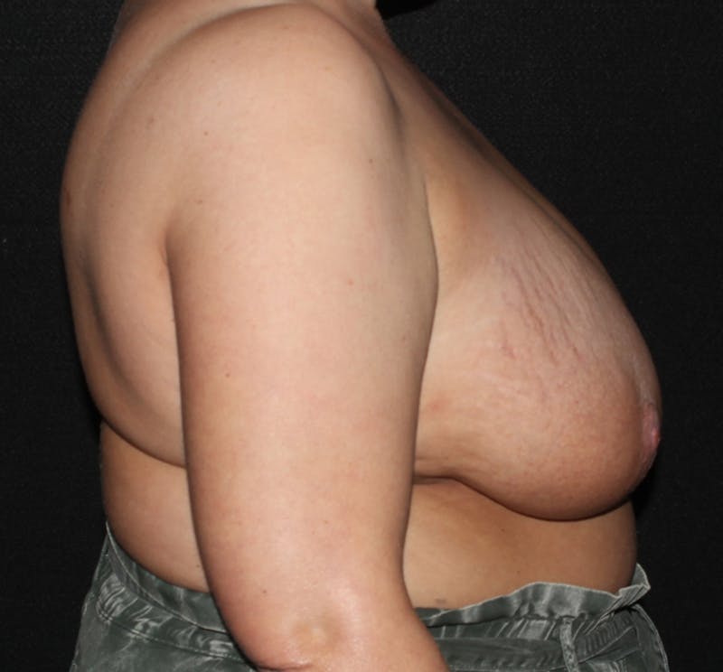 Breast Reduction Before & After Gallery - Patient 278095 - Image 3