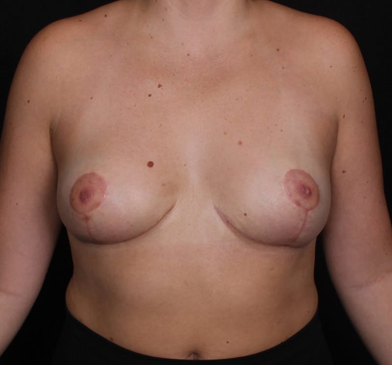 Breast Reduction Before & After Gallery - Patient 609685 - Image 2
