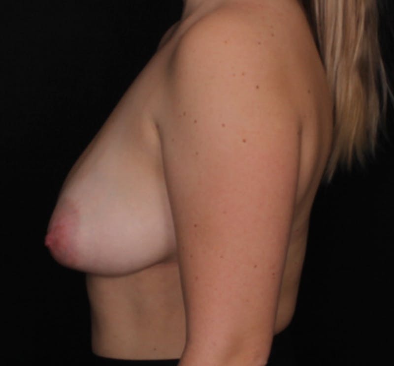 Breast Reduction Before & After Gallery - Patient 609685 - Image 3