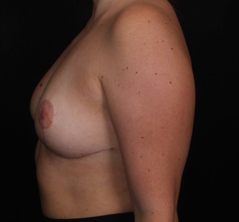 Breast Reduction Before & After Gallery - Patient 609685 - Image 4