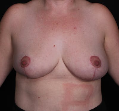 Breast Reduction Before & After Gallery - Patient 412848 - Image 2
