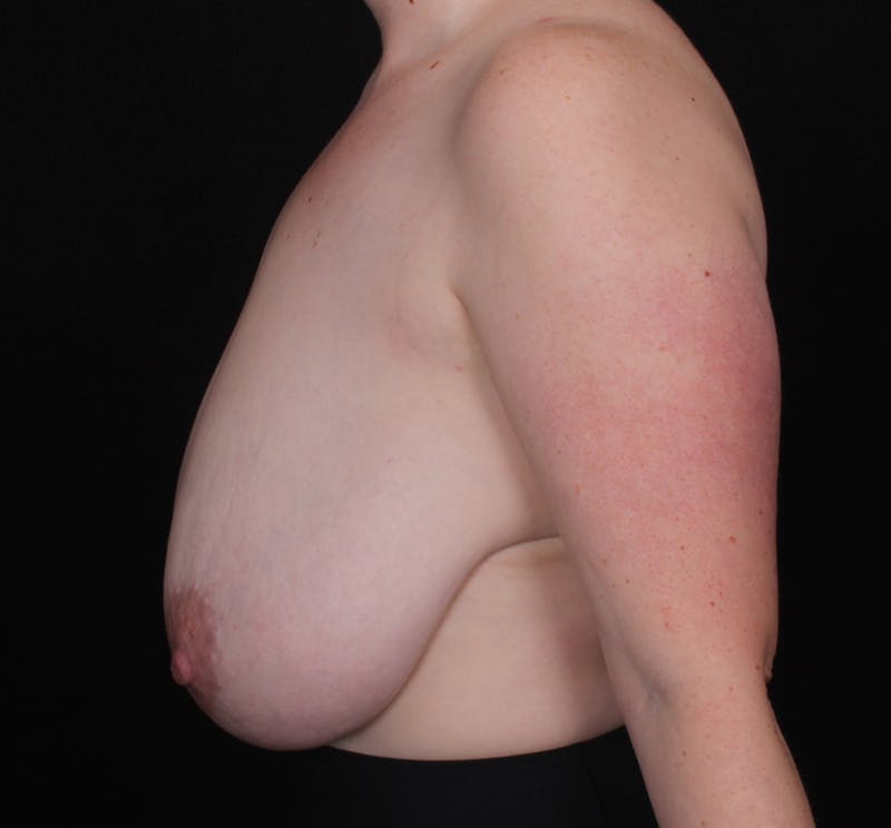 Breast Reduction Before & After Gallery - Patient 412848 - Image 3