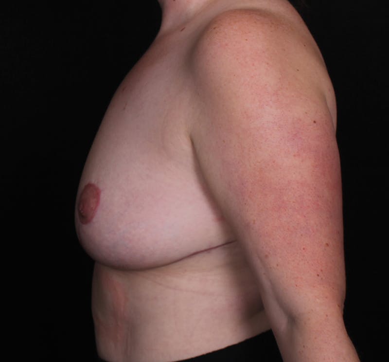 Breast Reduction Before & After Gallery - Patient 412848 - Image 4