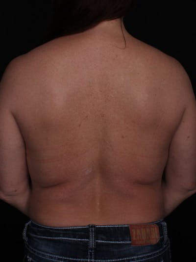 Upper Body Lift Before & After Gallery - Patient 764563 - Image 1