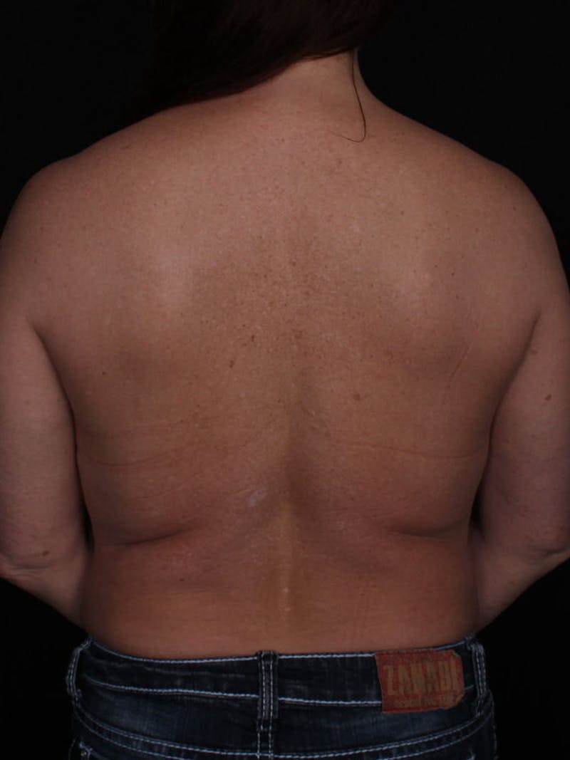 Upper Body Lift Before & After Gallery - Patient 764563 - Image 1