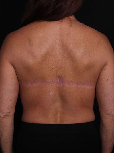 Upper Body Lift Before & After Gallery - Patient 764563 - Image 2