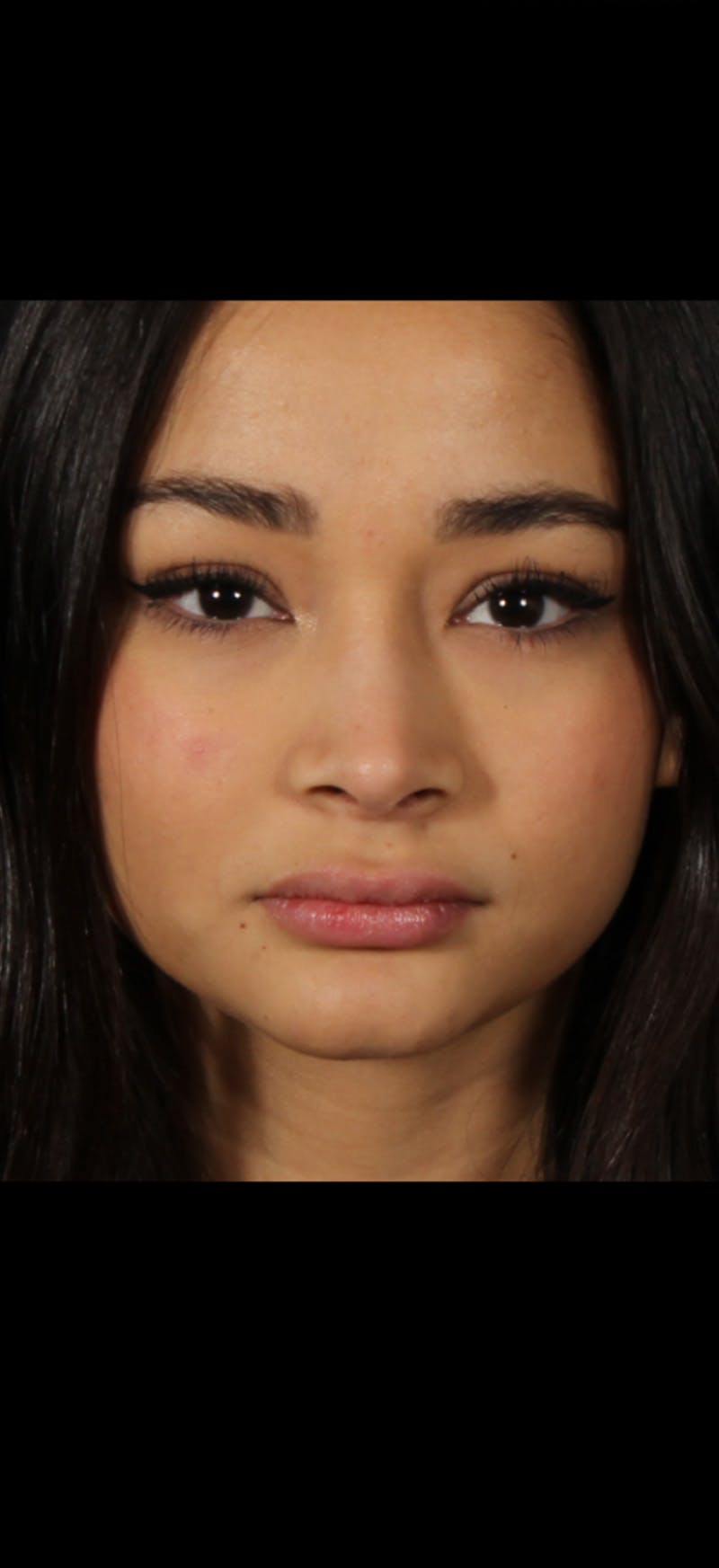 Rhinoplasty Female Before & After Gallery - Patient 349704 - Image 6
