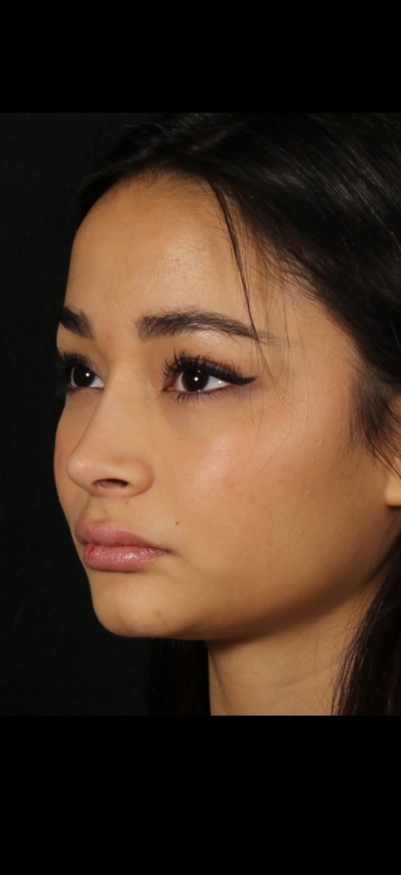 Rhinoplasty Female Before & After Gallery - Patient 349704 - Image 4