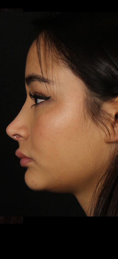 Rhinoplasty Female Before & After Gallery - Patient 349704 - Image 2