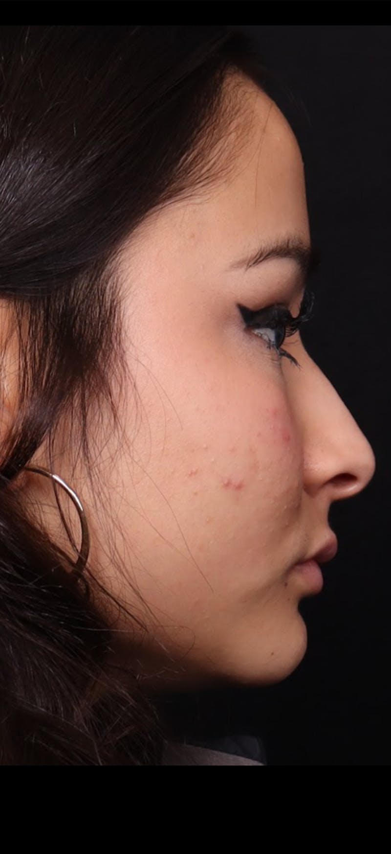 Rhinoplasty Female Before & After Gallery - Patient 349704 - Image 9