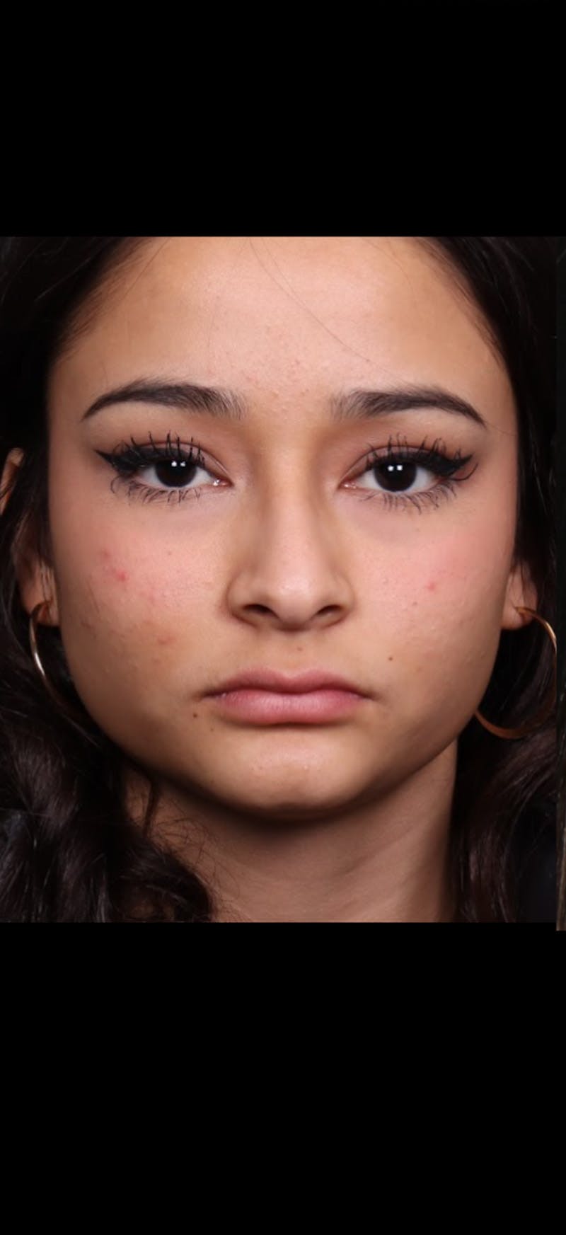 Rhinoplasty Female Before & After Gallery - Patient 349704 - Image 5
