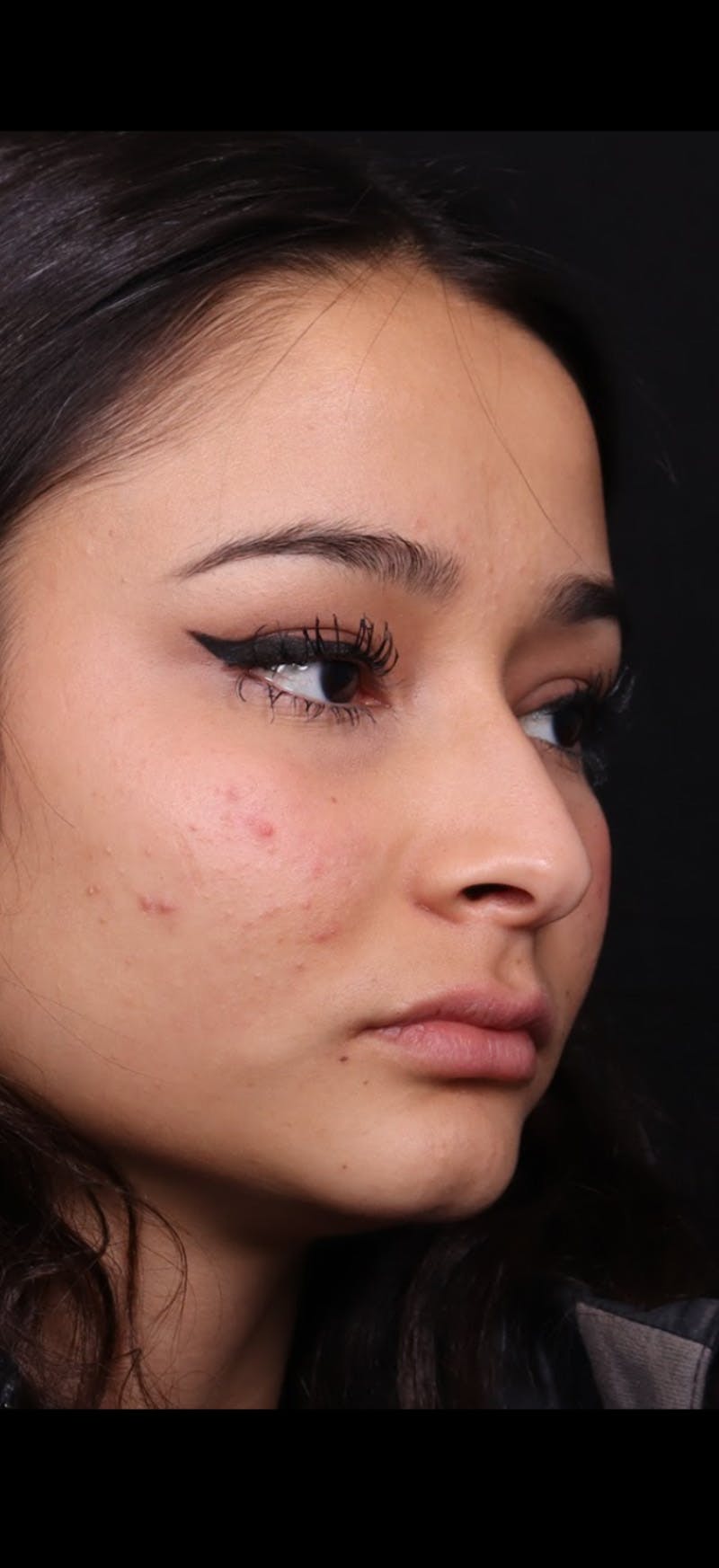 Rhinoplasty Female Before & After Gallery - Patient 349704 - Image 7