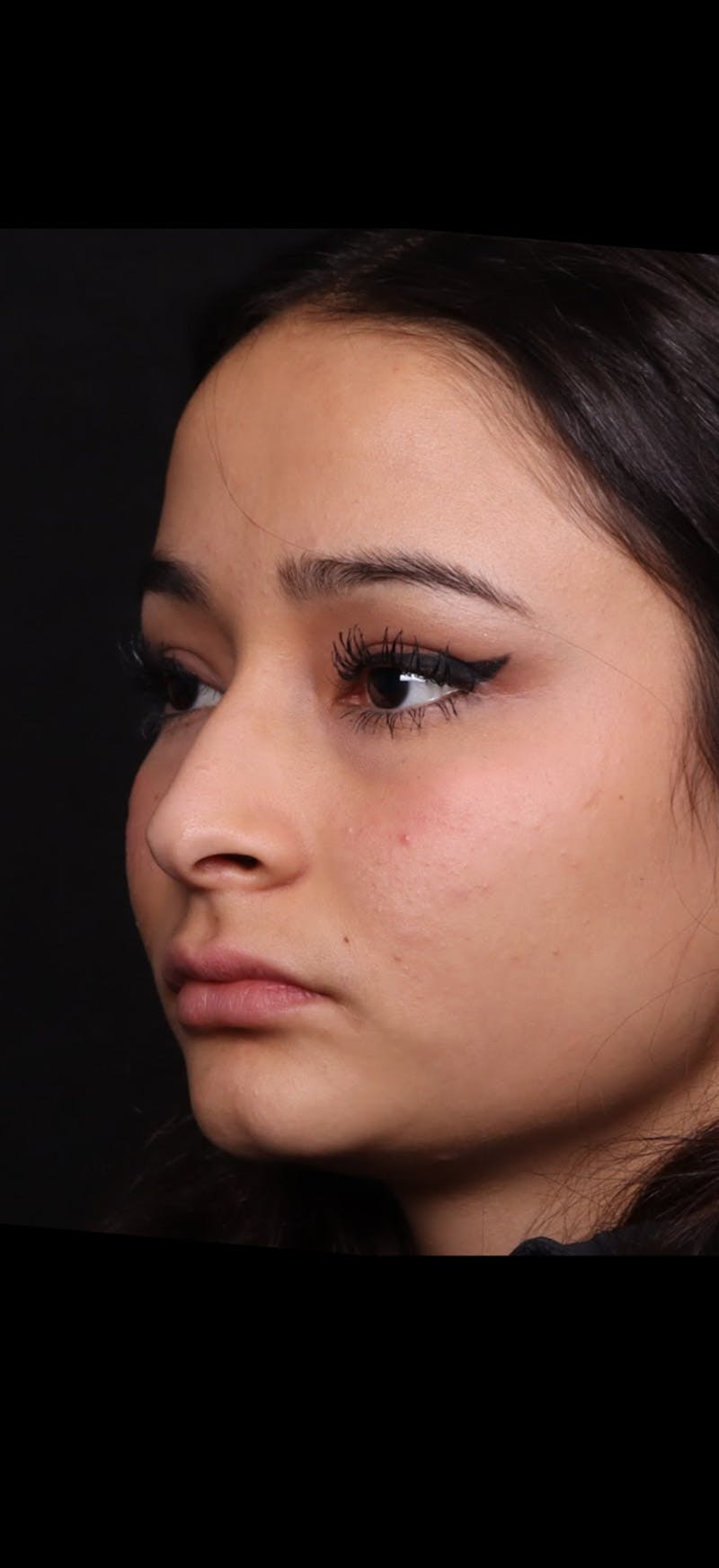 Rhinoplasty Female Before & After Gallery - Patient 349704 - Image 3