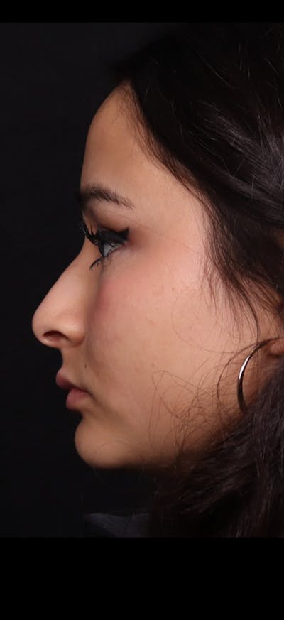 Rhinoplasty Female Before & After Gallery - Patient 349704 - Image 1