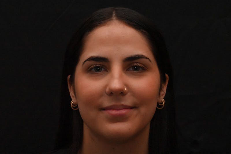 Rhinoplasty Before & After Gallery - Patient 603855 - Image 3