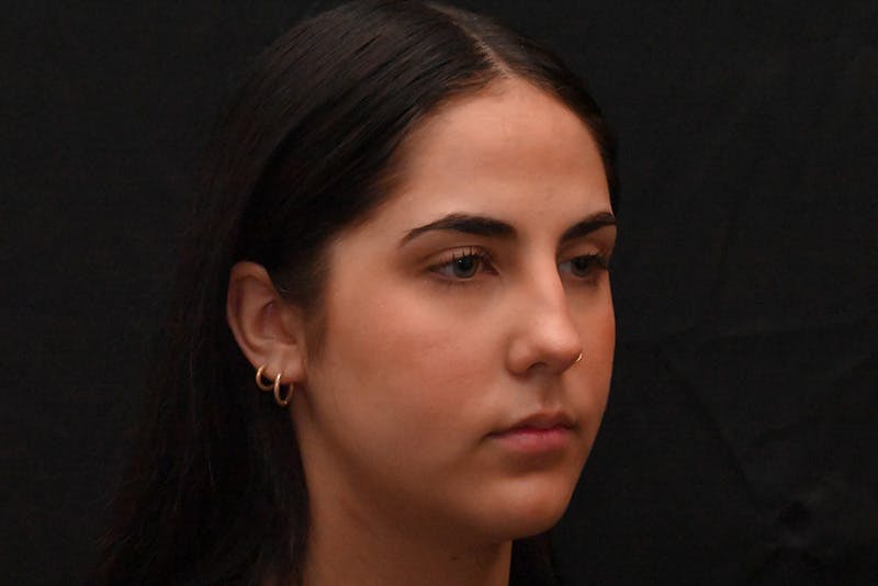 Rhinoplasty Before & After Gallery - Patient 603855 - Image 5