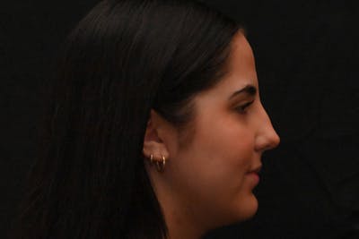 Rhinoplasty Before & After Gallery - Patient 603855 - Image 1