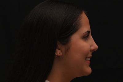 Rhinoplasty Before & After Gallery - Patient 603855 - Image 2