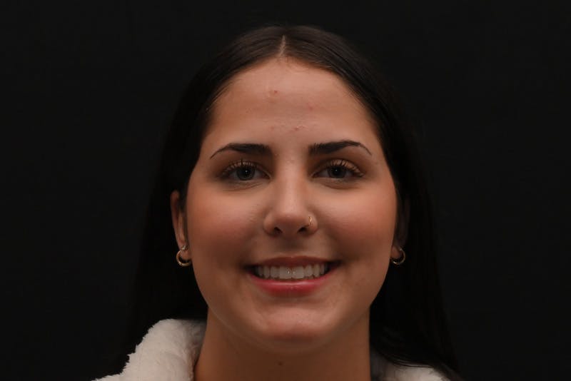 Rhinoplasty Before & After Gallery - Patient 603855 - Image 4