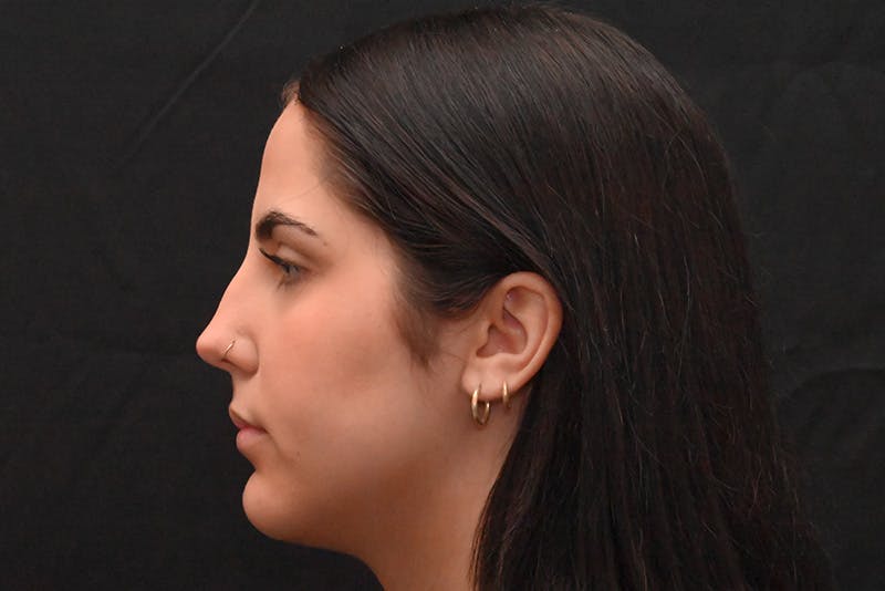 Rhinoplasty Before & After Gallery - Patient 603855 - Image 9