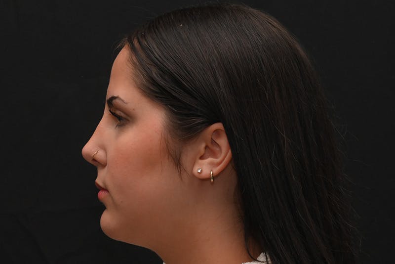 Rhinoplasty Before & After Gallery - Patient 603855 - Image 10