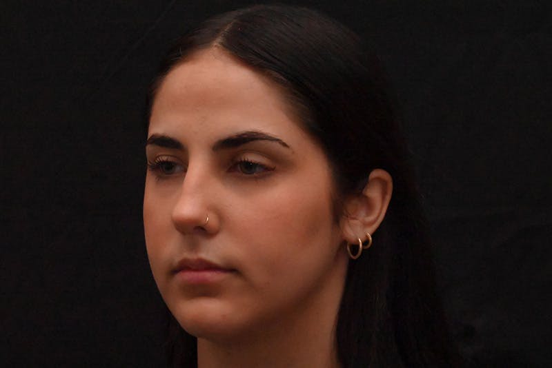 Rhinoplasty Before & After Gallery - Patient 603855 - Image 7