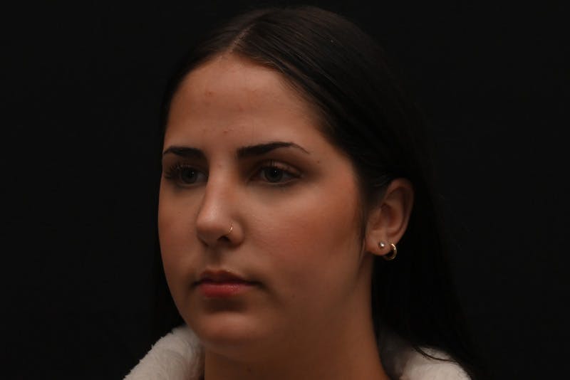 Rhinoplasty Before & After Gallery - Patient 603855 - Image 8