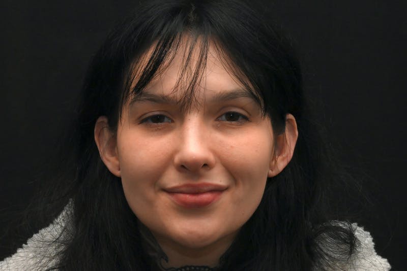 Rhinoplasty Before & After Gallery - Patient 208857 - Image 4
