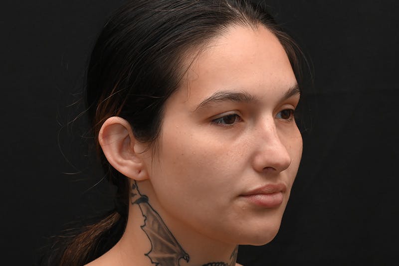 Rhinoplasty Before & After Gallery - Patient 208857 - Image 5