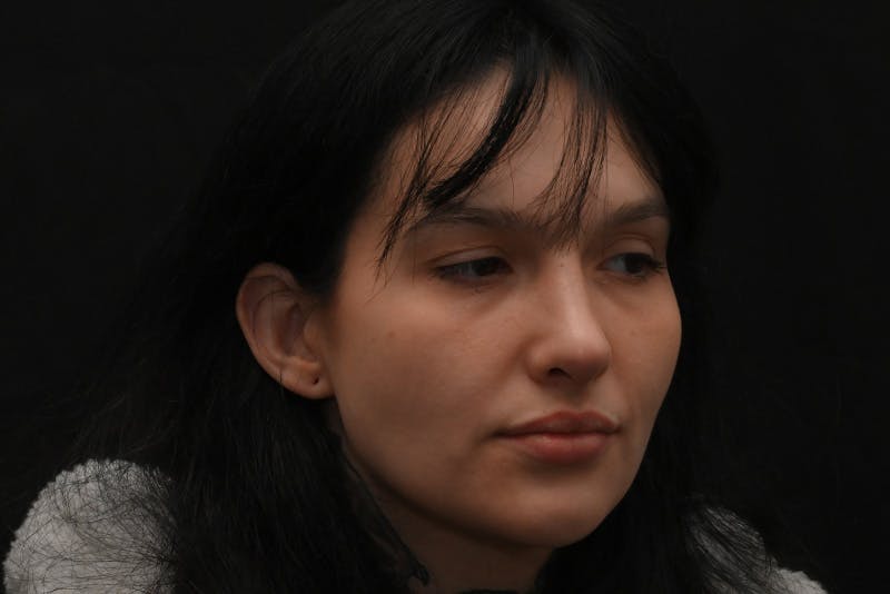 Rhinoplasty Before & After Gallery - Patient 208857 - Image 6
