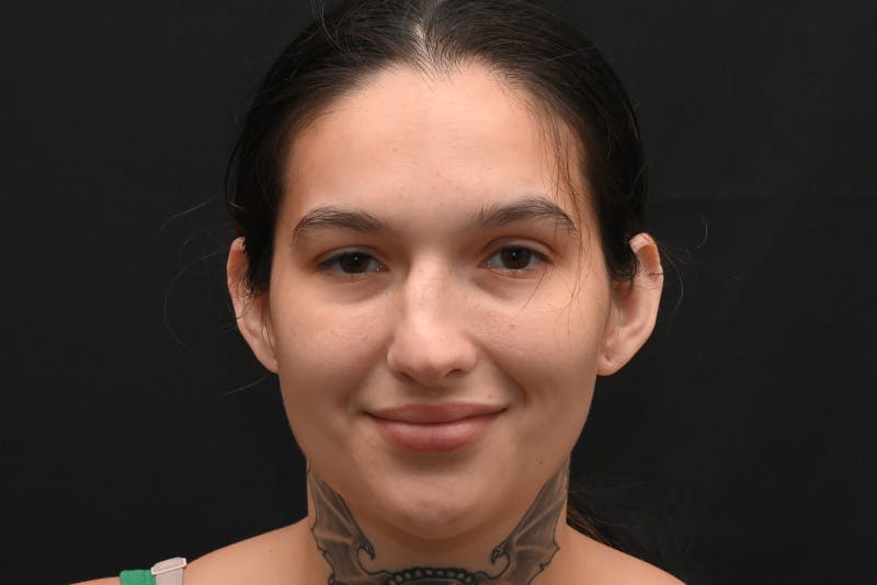 Rhinoplasty Before & After Gallery - Patient 208857 - Image 3