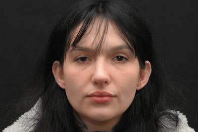 Rhinoplasty Before & After Gallery - Patient 208857 - Image 2