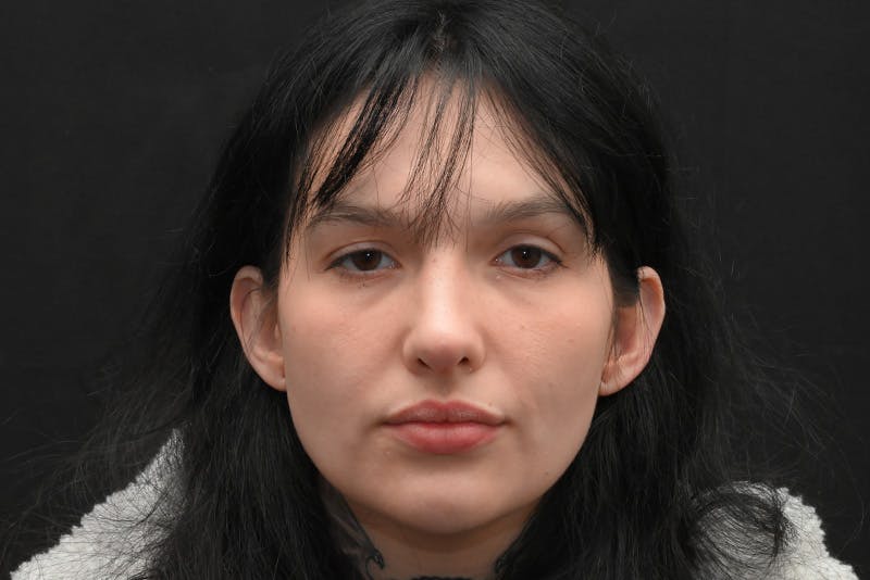 Rhinoplasty Before & After Gallery - Patient 208857 - Image 2