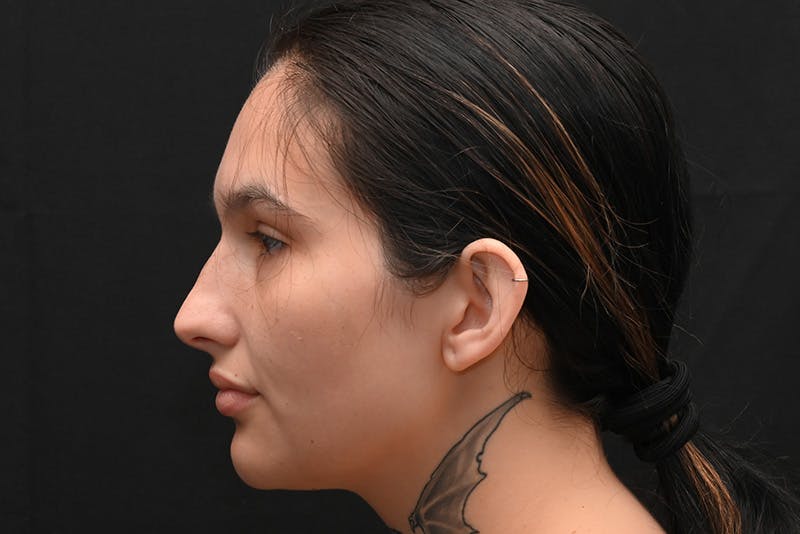 Rhinoplasty Before & After Gallery - Patient 208857 - Image 13