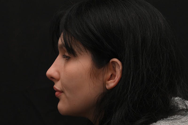 Rhinoplasty Before & After Gallery - Patient 208857 - Image 14