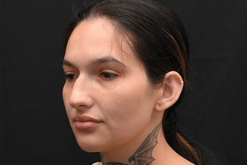 Rhinoplasty Before & After Gallery - Patient 208857 - Image 11