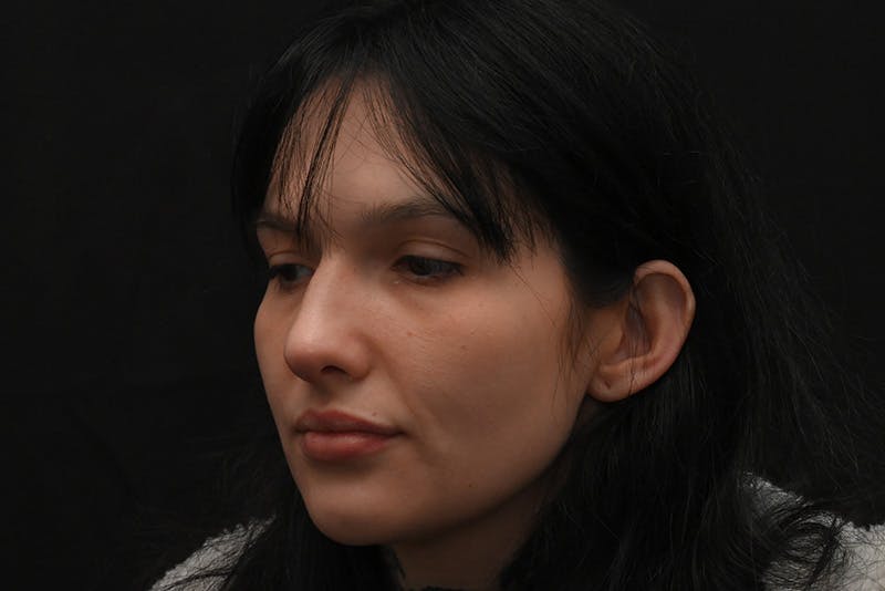 Rhinoplasty Before & After Gallery - Patient 208857 - Image 12