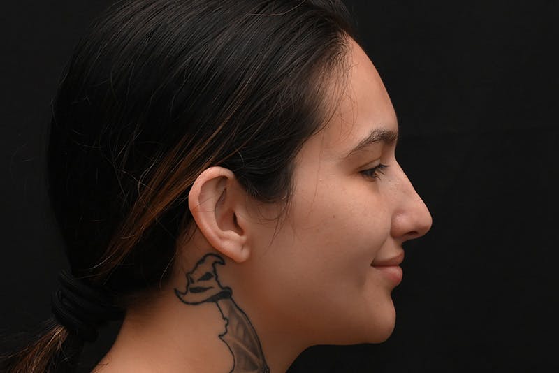 Rhinoplasty Before & After Gallery - Patient 208857 - Image 9