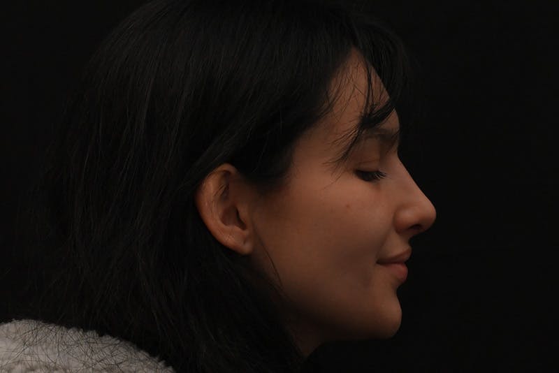 Rhinoplasty Before & After Gallery - Patient 208857 - Image 10