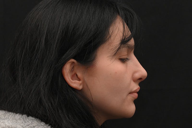 Rhinoplasty Before & After Gallery - Patient 208857 - Image 8