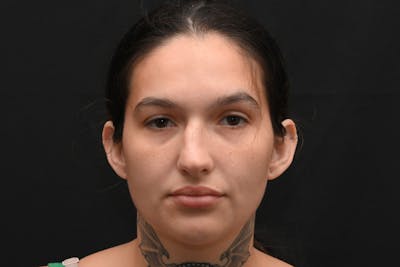 Rhinoplasty Before & After Gallery - Patient 208857 - Image 1