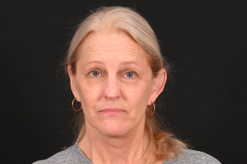 Facelift Before & After Gallery - Patient 762765 - Image 6