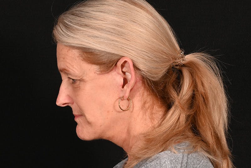 Facelift Before & After Gallery - Patient 762765 - Image 20